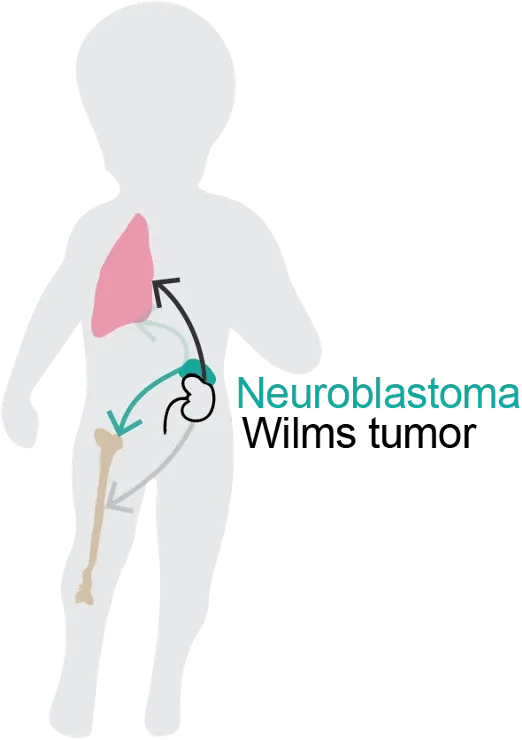 Research figure — metastatic spread